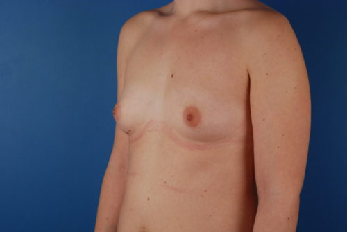 Breast Augmentation Before and After | Kiran Gill MD