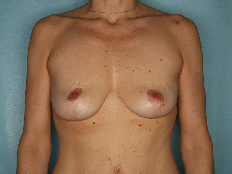 Breast Implant Removal Before and After | Kiran Gill MD