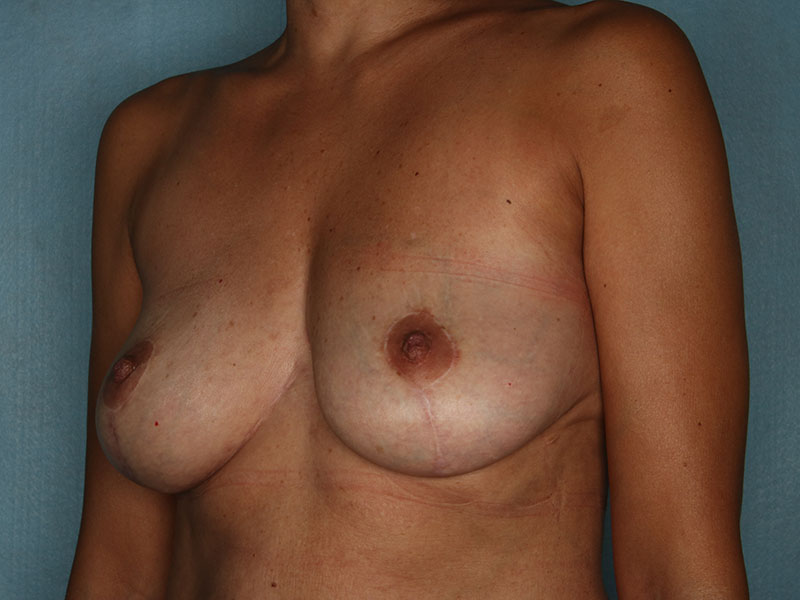 Breast Reduction Before and After | Kiran Gill MD