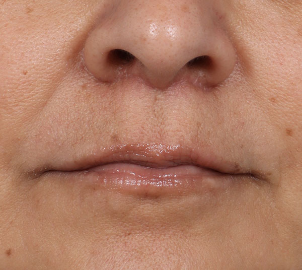 Lip Lift Before and After | Kiran Gill MD