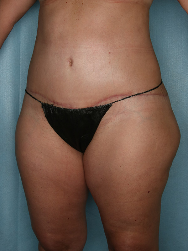 Liposuction Before and After | Kiran Gill MD