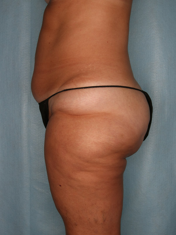 Liposuction Before and After | Kiran Gill MD