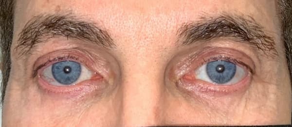 Blepharoplasty Before and After | Kiran Gill MD