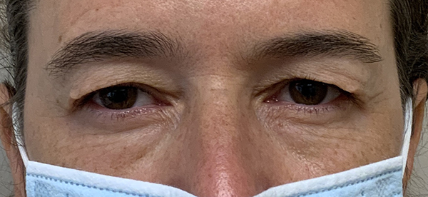 Blepharoplasty Before and After | Kiran Gill MD