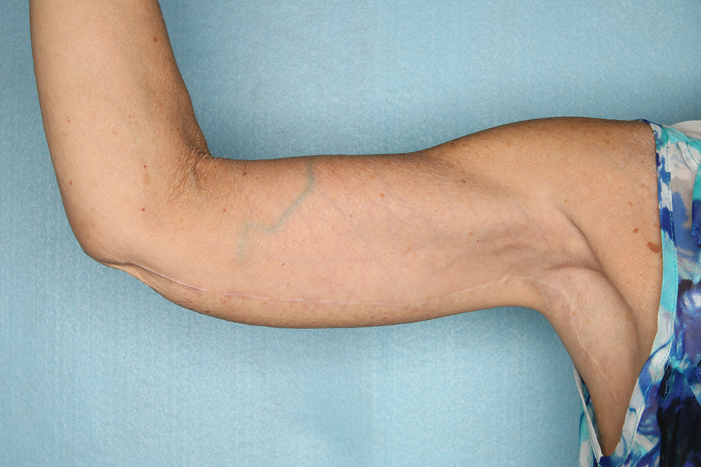 Brachioplasty Arm Lift Before and After | Kiran Gill MD