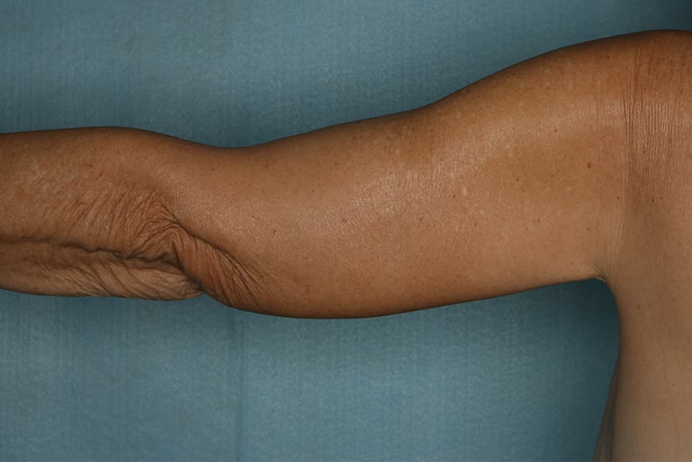 Brachioplasty Arm Lift Before and After | Kiran Gill MD