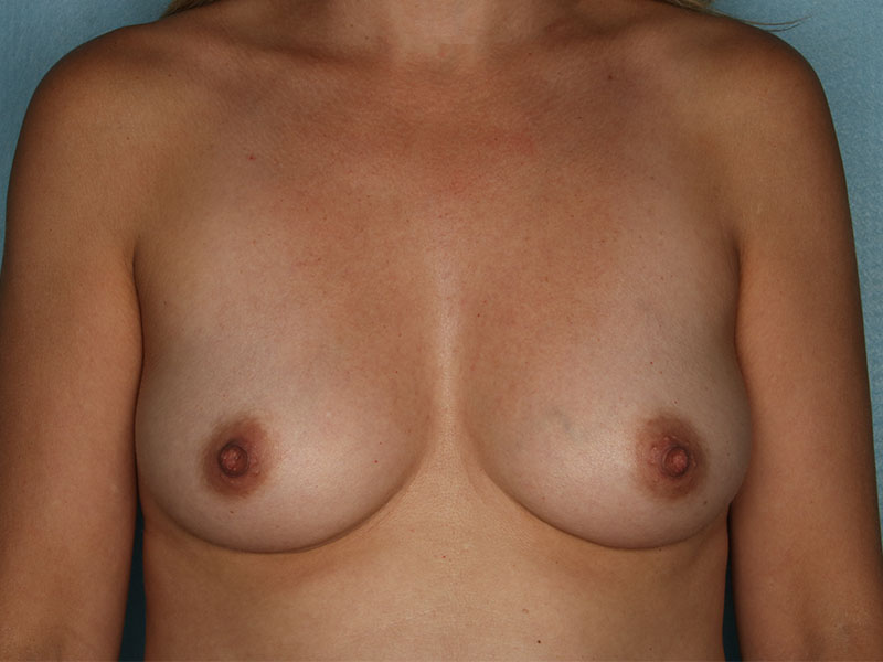 Breast Augmentation Before and After | Kiran Gill MD
