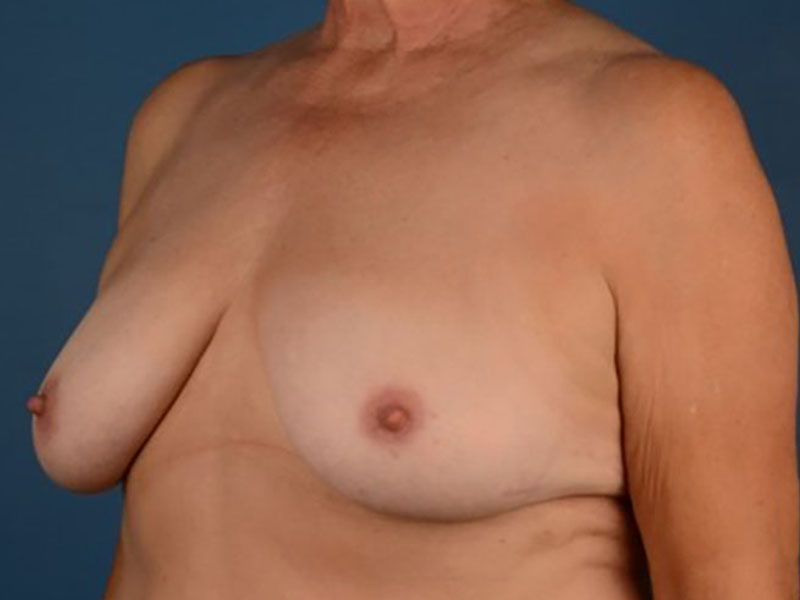 Breast Lift in Naples FL Before & After Photo 05