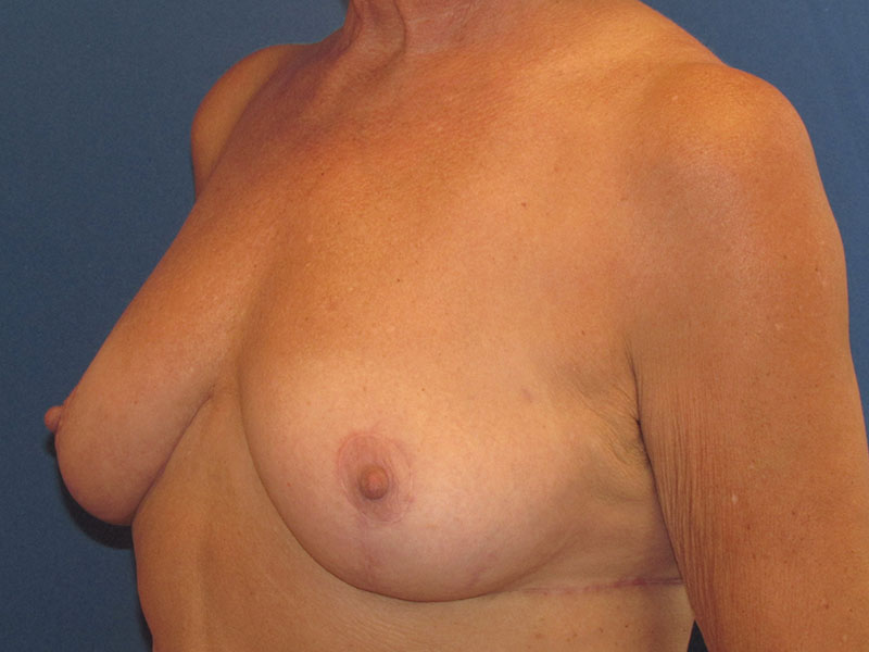 Breast Lift in Naples FL Before & After Photo 06