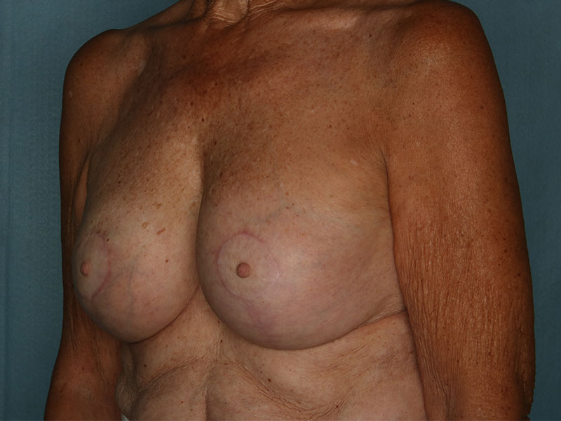 Breast Lift Before and After | Kiran Gill MD
