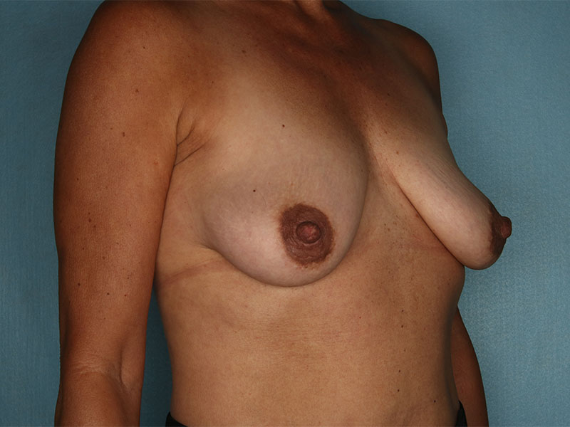 Breast Lift Before and After | Kiran Gill MD