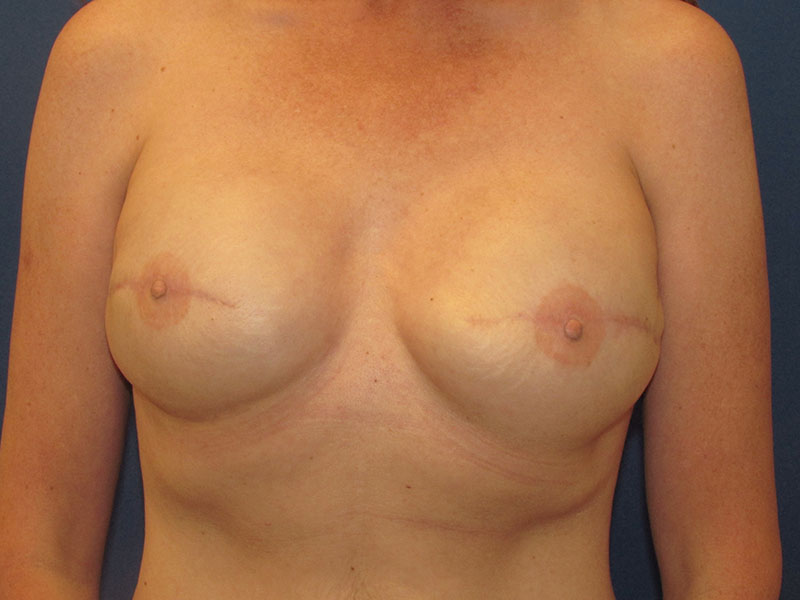 Breast Reconstruction Before and After | Kiran Gill MD