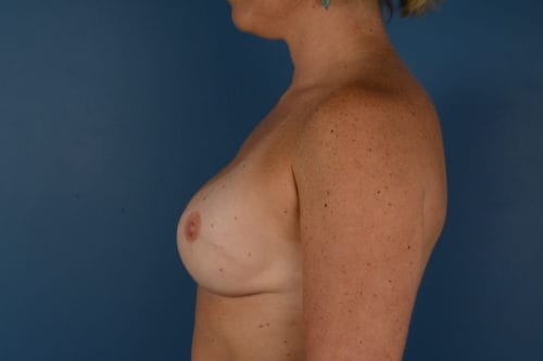 Breast Reconstruction Before and After | Kiran Gill MD