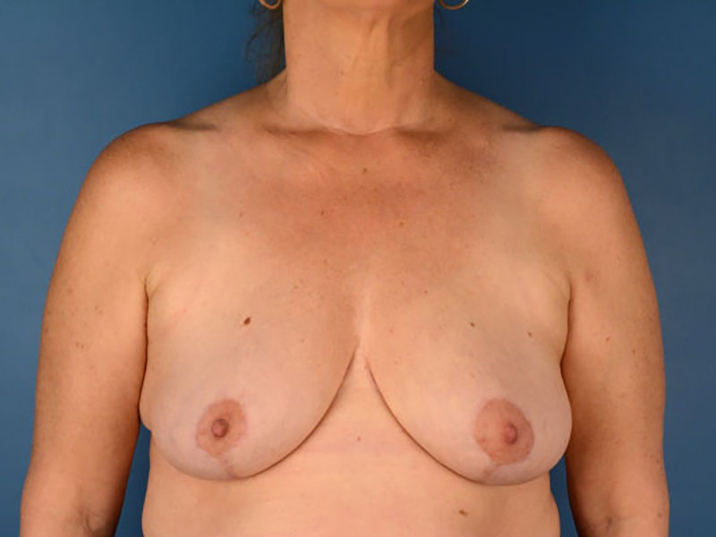 Breast Reduction Before and After | Kiran Gill MD