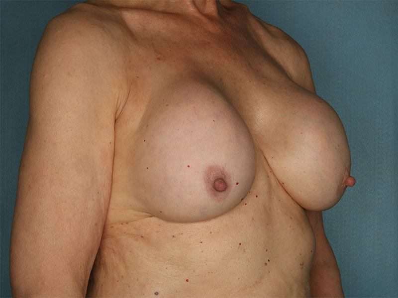 Breast Revision Before and After | Kiran Gill MD