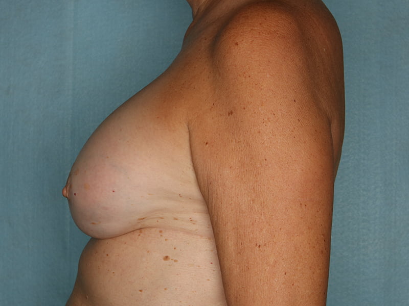 Breast Revision Before and After | Kiran Gill MD