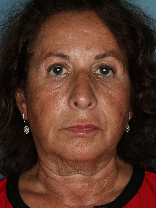 Face Lift Before and After | Kiran Gill MD