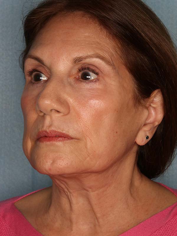 Face Lift Before and After | Kiran Gill MD