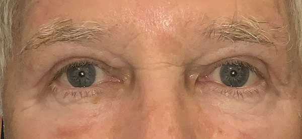 Functional Blepharoplasty Before and After | Kiran Gill MD