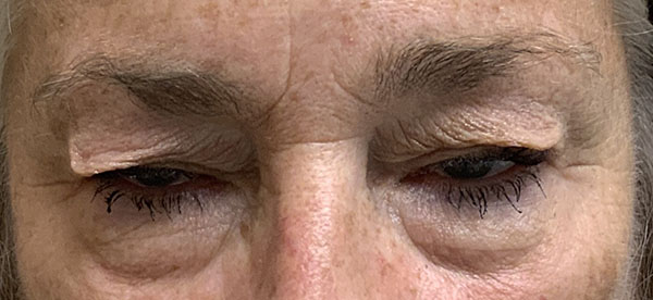 Functional Blepharoplasty Before and After | Kiran Gill MD