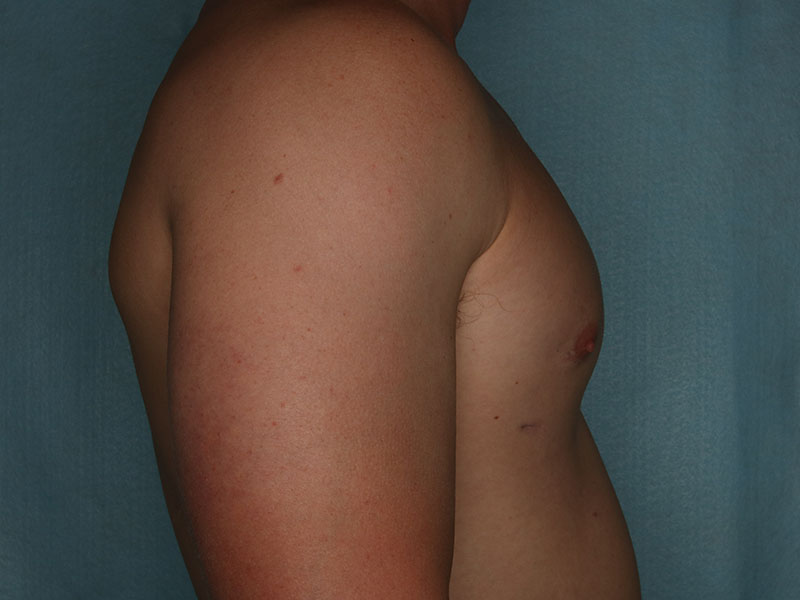 Gynecomastia Before and After | Kiran Gill MD