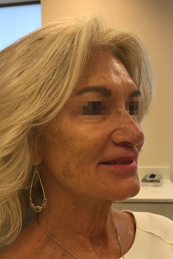 Injectables Before and After | Kiran Gill MD