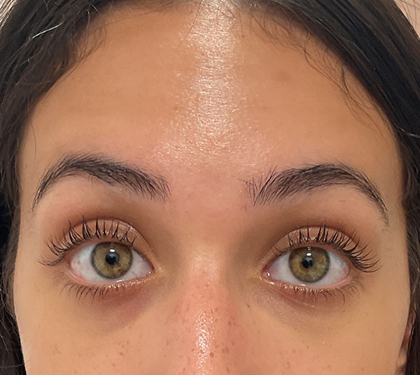 Injectables Before and After | Kiran Gill MD