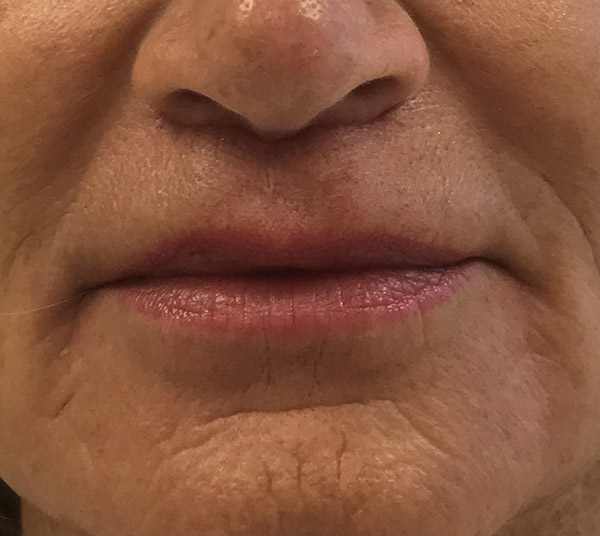 Lip Lift Before and After | Kiran Gill MD