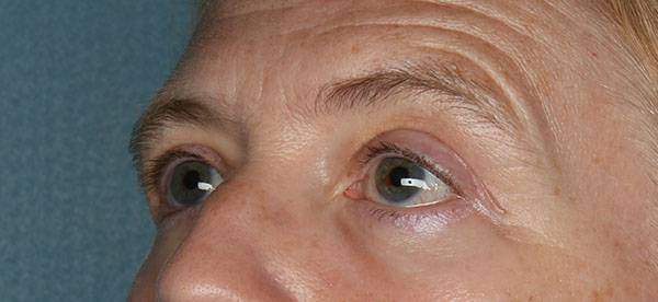 Lower Blepharoplasty Before and After | Kiran Gill MD