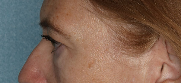 Lower Blepharoplasty Before and After | Kiran Gill MD