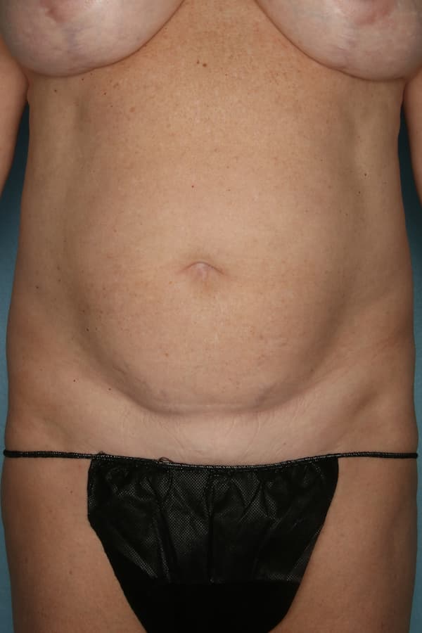 Mini Tummy Tuck Before and After | Kiran Gill MD
