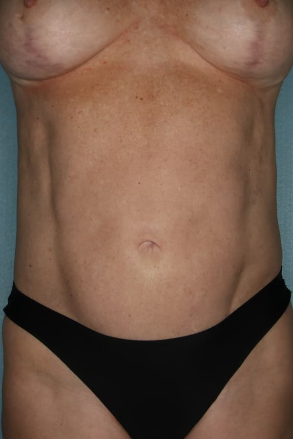 Mini Tummy Tuck Before and After | Kiran Gill MD