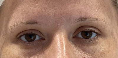 Permanent Makeup Before and After | Kiran Gill MD