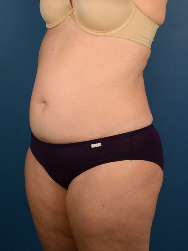 Naples FL Tummy Tuck Before & After Photo 2 - 03