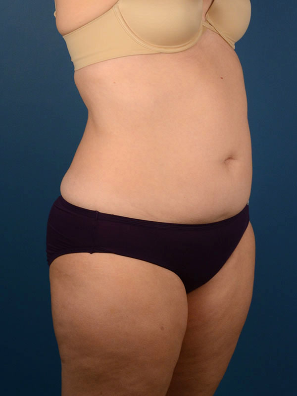 Naples FL Tummy Tuck Before & After Photo 2 - 05