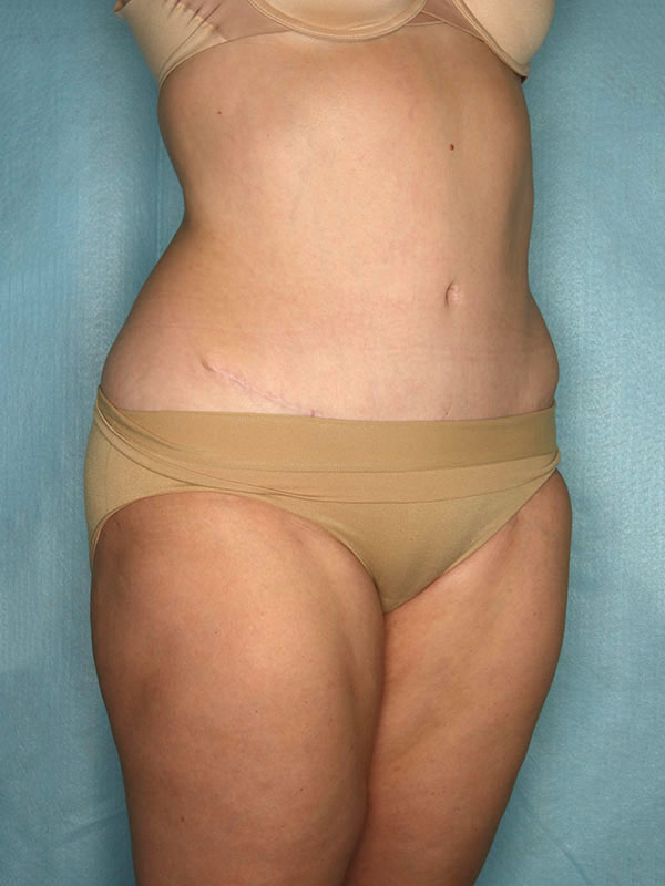 Naples FL Tummy Tuck Before & After Photo 2 - 06