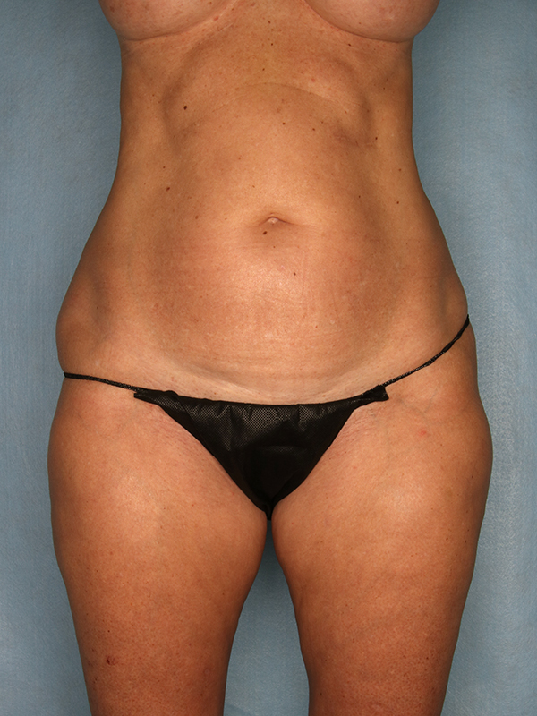 Naples FL Tummy Tuck Before & After Photo 01