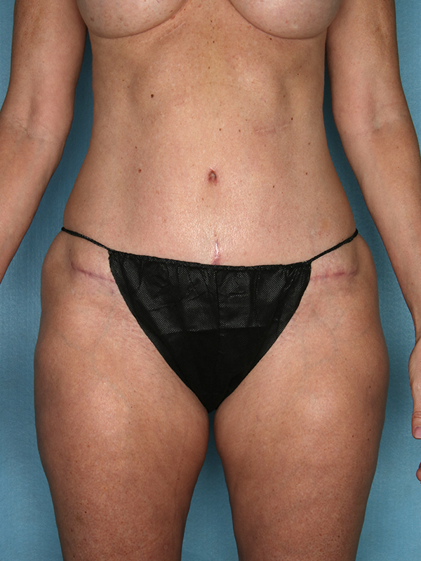 Naples FL Tummy Tuck Before & After Photo 02