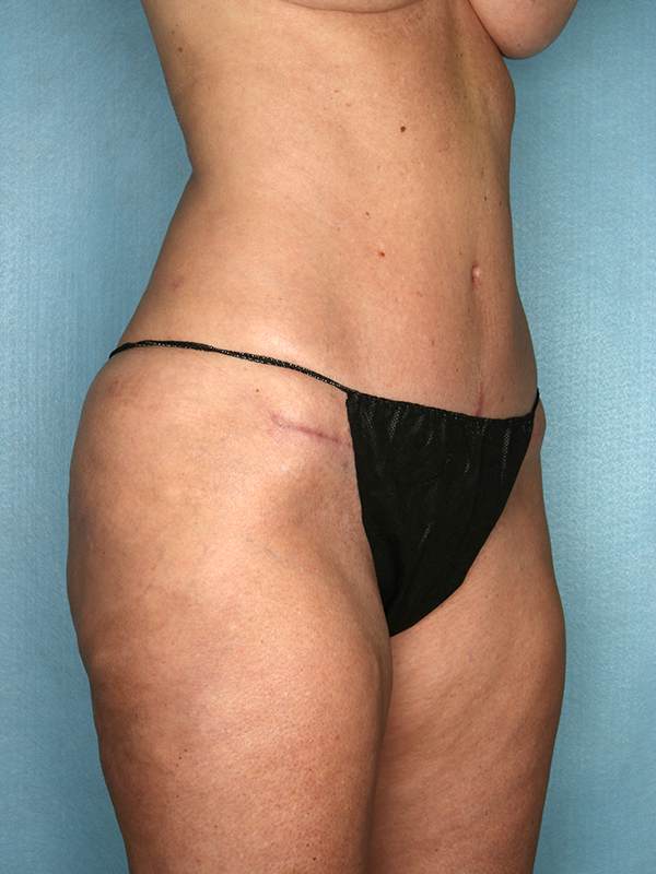 Naples FL Tummy Tuck Before & After Photo 04