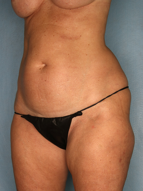 Tummy Tuck Before and After | Kiran Gill MD