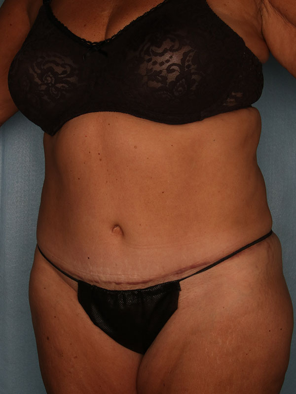 Tummy Tuck Before and After | Kiran Gill MD