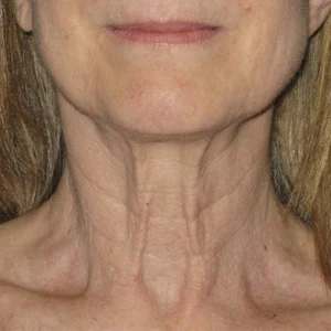 Ultherapy-0028-0086W_0Day_BEFORE_Neck_low-res
