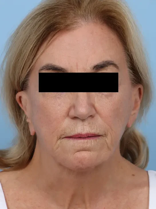 Case # 30 before photo