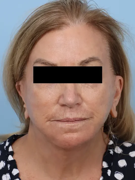 Case # 2 after photo