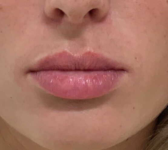 Case # 32 after photo