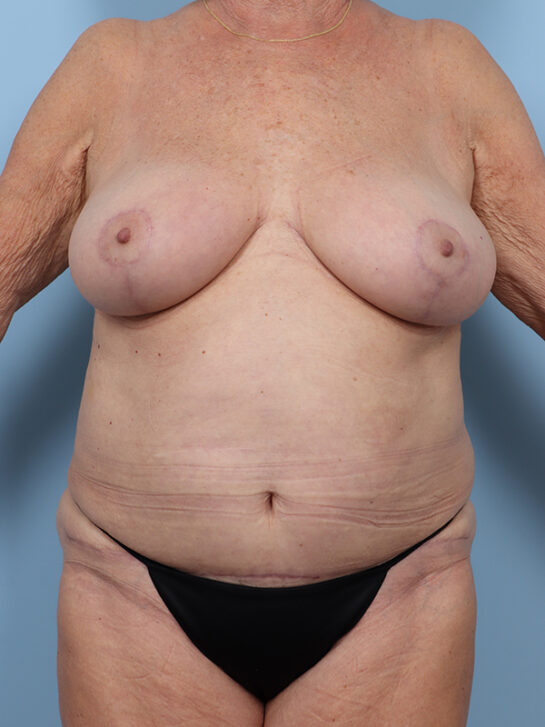 Case # 9 after photo