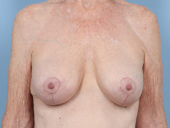 Case # 41 after photo