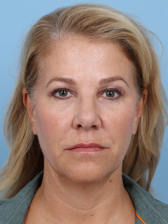 Case # 29 before photo