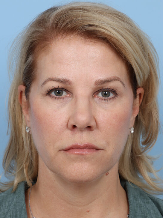 Case # 29 after photo