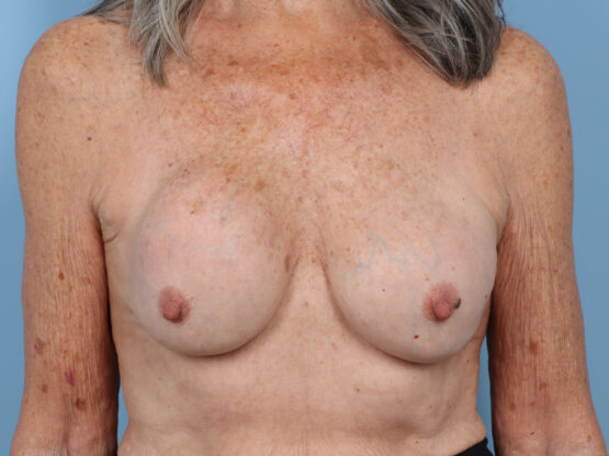 Case # 32 before photo